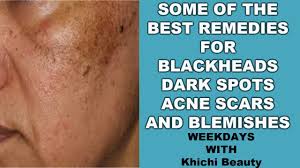 blackheads acne scars dark spot