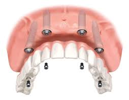 implanturi dentare implant dentar de