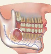pericoronitis what it is and what the