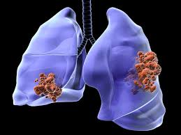 Un polmone di un fumatore e un polmone sano: Tumore Al Polmone I Sintomi Le Cause La Diagnosi E La Cura Ohga