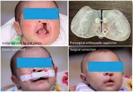pas of children with cleft lip