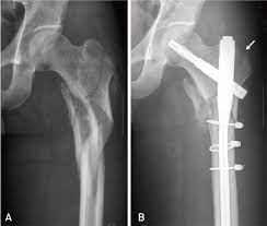 intertrochanteric fem fracture