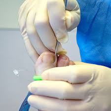 mackay ingrown toenail clinic