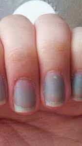5 signs of vitamin b12 deficiency on nails