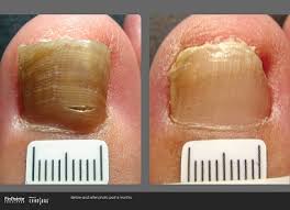 best treatments for toenail fungus