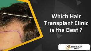 which hair transplant clinic is the