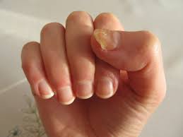 natural remes for treating nail