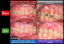 gum graft bayside periodontics