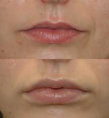 upper lip shortening and lip