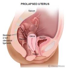 pelvic organ prolapse atlanta uterine