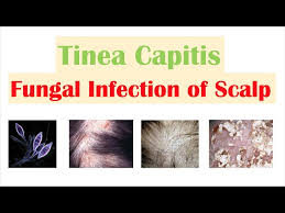 fungal infection of the scalp tinea