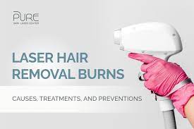 laser hair removal burns causes