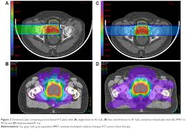proton beam therapy clinical utility