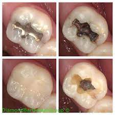 How to reverse it and avoid a cavity. Diamond Bar Dental Group On Instagram A Clean Cavity Prep Is A Must Amalgam Fillings Can Break The Tooth By Mak Dental Amalgam Fillings Tooth Decay Remedies
