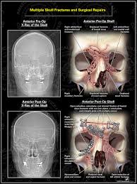 skull fractures and surgical repairs