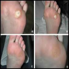 Plantar warts are painful warts on the sole of the foot. How Should I Get Rid Of Warts Permanently Quora