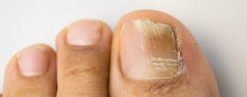fungal skin or nail infections causes