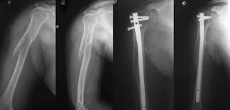 proximal humeral fracture