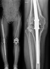 infected knee arthroplasties