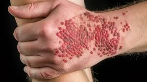 hiv rashes picture background images