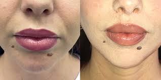 lip lift surgery and treatments from