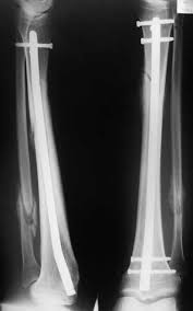 postoperative x rays of tibial fracture