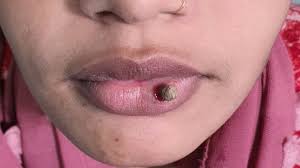 lip warts removed with laser treatment