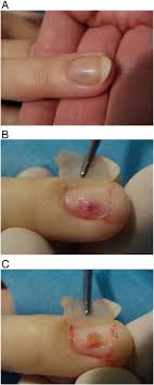 nail tumors sciencedirect