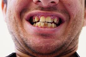 crooked teeth a serious health risk