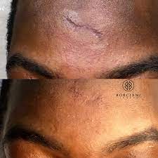 scar camouflage scar removal and scar