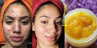 home remes to fade acne scars