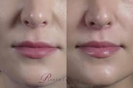 lip lift vs lip filler which should