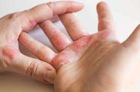 how to treat eczema dry itchy skin