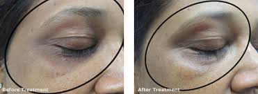 periorbital pigmentation treatment at