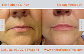 lip augmentation