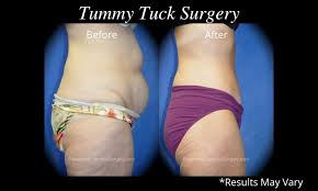 what can a tummy tuck address what can