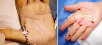 trigger finger treatment in abu dhabi uae
