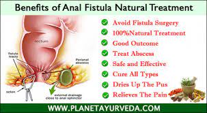 fistula natural treatment