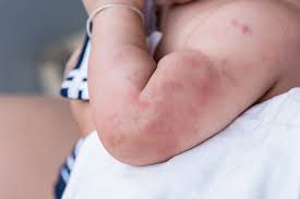 17 most common types of baby rashes