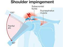 shoulder impingement syndrome causes