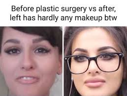 before plastic surgery vs after left