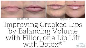 botox lip lift