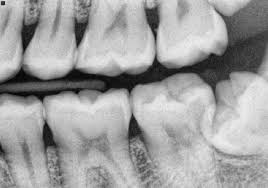 Check spelling or type a new query. Bitewing Dental X Rays News Dentagama