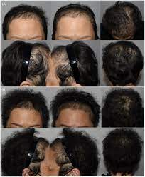 aromatase inhibitor induced alopecia
