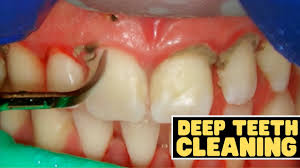 teeth cleaning vs deep cleaning