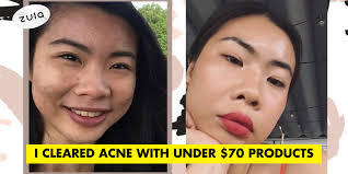 how i cleared acne with under s 70