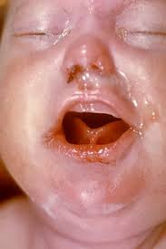 Syphilis is still a relatively common disease. Congenital Syphilis Wikipedia