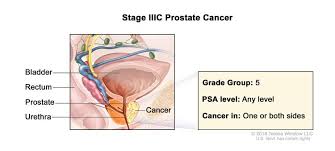 Now, before i list the top 5 warning signs, let's first start with the top 5 risk factors. Prostate Cancer Signs Diagnosis Treatment Understanding Prostate Cancer Treatment By Stage Cleveland Oh University Hospitals