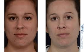 rosacea and spider vein treatment