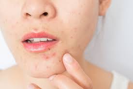 how to cope with acne in the rainy season
